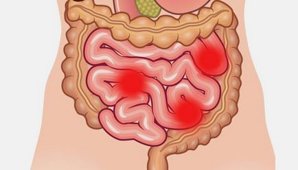 Симптоми паразитів в кишечнику людини явні ознаки зараження