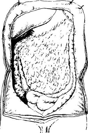 Simptomele perforării ulcerului - diagnosticarea unui abdomen acut
