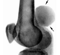 Synovioma - cauze, simptome, diagnostic și tratament