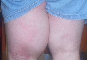 Synovium simptome și tratamentul de umflare a încheieturii, articulației genunchiului, etc.