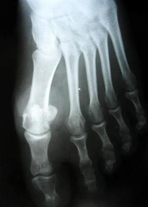 Synovium simptome și tratamentul de umflare a încheieturii, articulației genunchiului, etc.