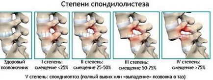 Deplasarea simptomelor vertebrelor cervicale și tratamentul regiunii cervicale la copil