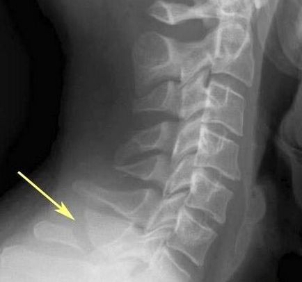 Deplasarea simptomelor vertebrelor cervicale și tratamentul regiunii cervicale la copil