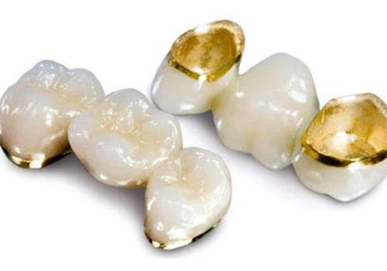 Clinica dentara de medic Livshits - protetica dintilor cu aur, fabricarea metalelor pretioase