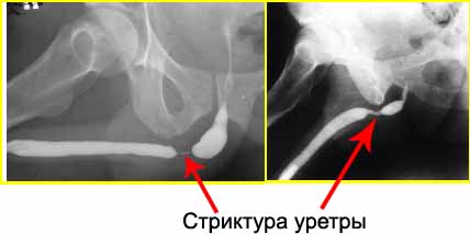 Structuri ale diagnosticului uretrei, simptome