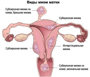 Leiomiom submucos al uterului, ce este