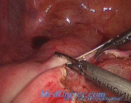 Tehnica de laparoscopie în ginecologie este diagnosticarea, sterilizarea și separarea aderențelor