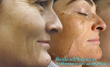 Tehnica peelingului chimic al feței
