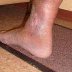 Ulcerul trofic pe picior cu tratamentul diabetului zaharat al insulinei inflamate, fotografie a membrelor inferioare