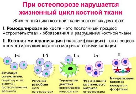 Tipuri de osteoporoză