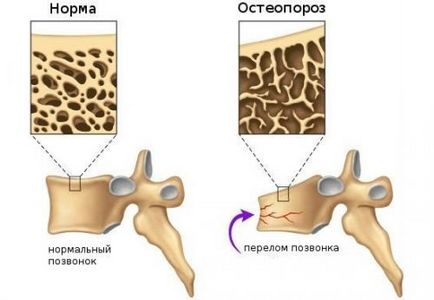 Tipuri de osteoporoză