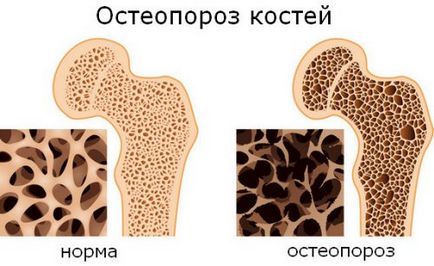 Tipuri de osteoporoză