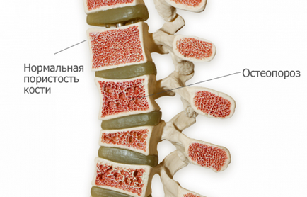 Tipuri de osteoporoză