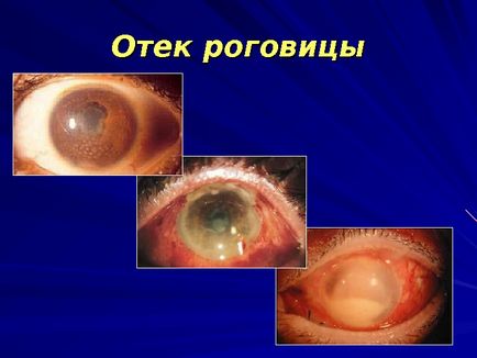 Posibile complicații după înlocuirea obiectivului cu cataractă