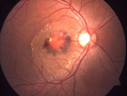 Posibile complicații după înlocuirea obiectivului cu cataractă