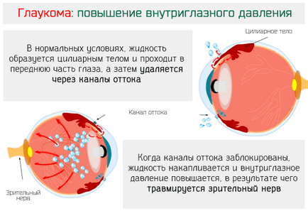 Можливі ускладнення після заміни кришталика ока при катаракті