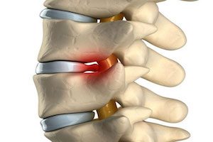 Este posibilă rezolvarea herniilor intervertebrale?