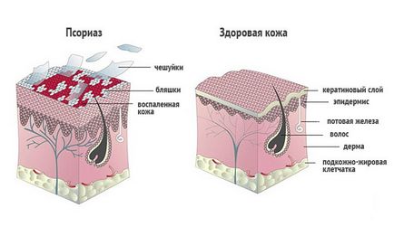 Posibilități de remedii folclorice pentru artrita psoriazică