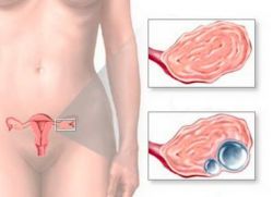 Boli ale ovarelor la femei