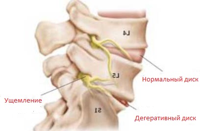 Strângerea simptomelor nervoase și a tratamentului, cauze, prevenirea