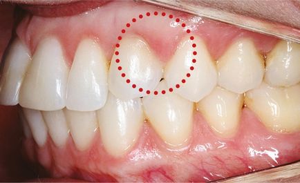 Dintele doare atunci cand preseaza complicatii dupa umplere, indepartarea nervilor si alte cauze ale stomatologiei