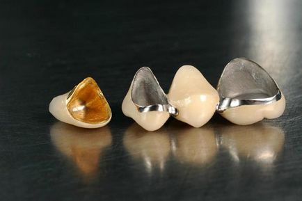 Зубна коронка з дорогоцінного металу