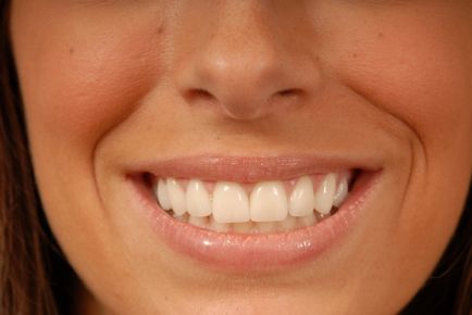 5 Egyszerű Ways, hogy megszabaduljon a fogszuvasodás - lehetséges, hogy megszabaduljon a fogszuvasodás -