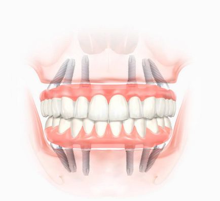 Implantul dentar pe toată lungimea - m