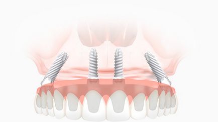 All-on-4 implantáció - m