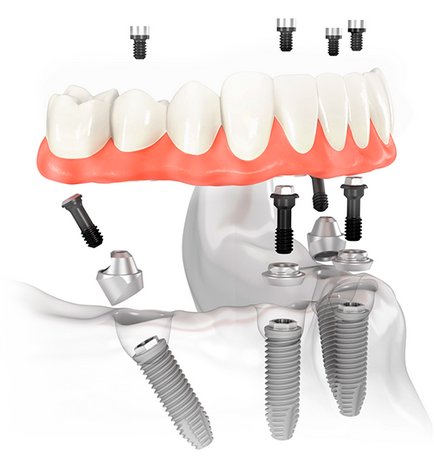 Implantul dentar pe toată lungimea - m