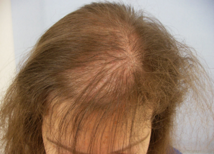 Alopecia la copii, cauze și fotografii ale alopeciei copilului