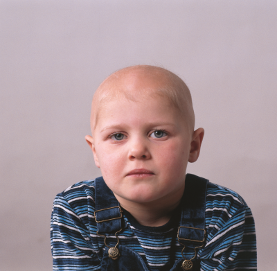 Alopecia la copii, cauze și fotografii ale alopeciei copilului