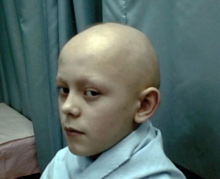 Alopecia la copii, cauze și fotografii ale alopeciei copilului