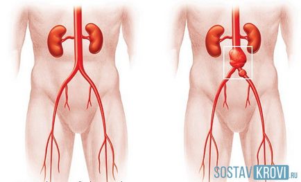 Аневризма черевної аорти справжня, помилкова, расслаивающая, причини, симптоми, лікування, операція,