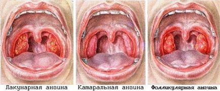 Angina tünetek gyermekeknél, kezelésére, megelőzésére, okozza a betegség