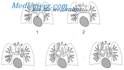 Atrezia arterei pulmonare