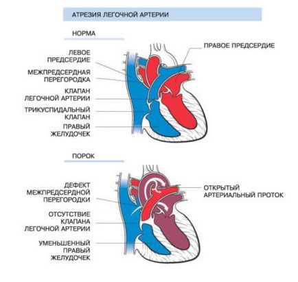 Atrezia arterei pulmonare 1