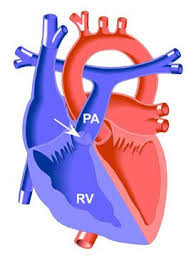 Atrezia arterei pulmonare, mc intercardio