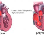 Atrezia arterei pulmonare - cauze, simptome și tratament