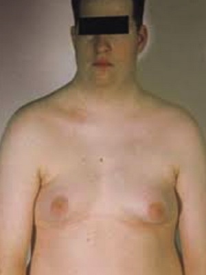 Boala sindromului clainfelter în fotografii bărbați bolnavi, semne ale bolii și tratamentul acesteia