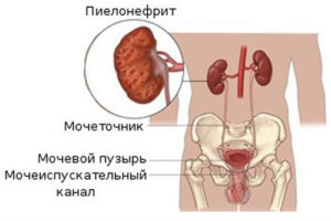 Than за лечение на пиелонефрит