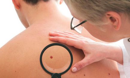 Ce este definiția melanomului, semnele primare, nivelul de pericol pentru viață, prevenirea, video