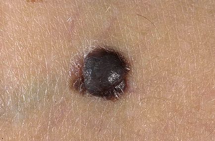 Ce este definiția melanomului, semnele primare, nivelul de pericol pentru viață, prevenirea, video