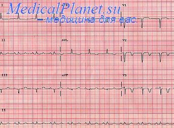 Criteriile ECG pentru infarctul miocardic