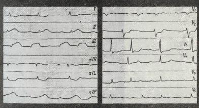 Criterii electrocardiografice pentru infarctul miocardic