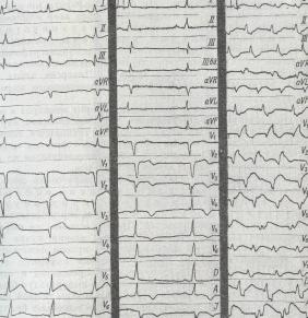 Criterii electrocardiografice pentru infarctul miocardic