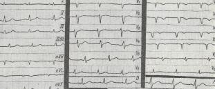 Criterii electrocardiografice pentru infarctul miocardic