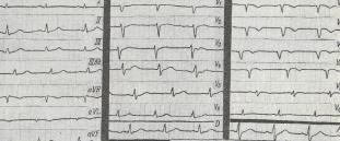 Електрокардіографічні критерії інфаркту міокарда