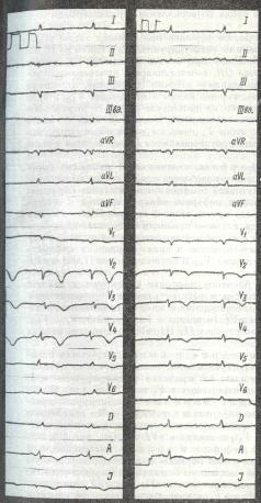 Criterii electrocardiografice pentru infarctul miocardic