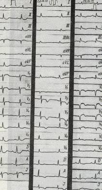 Elektrokardiográfiás kritériumok szívinfarktus